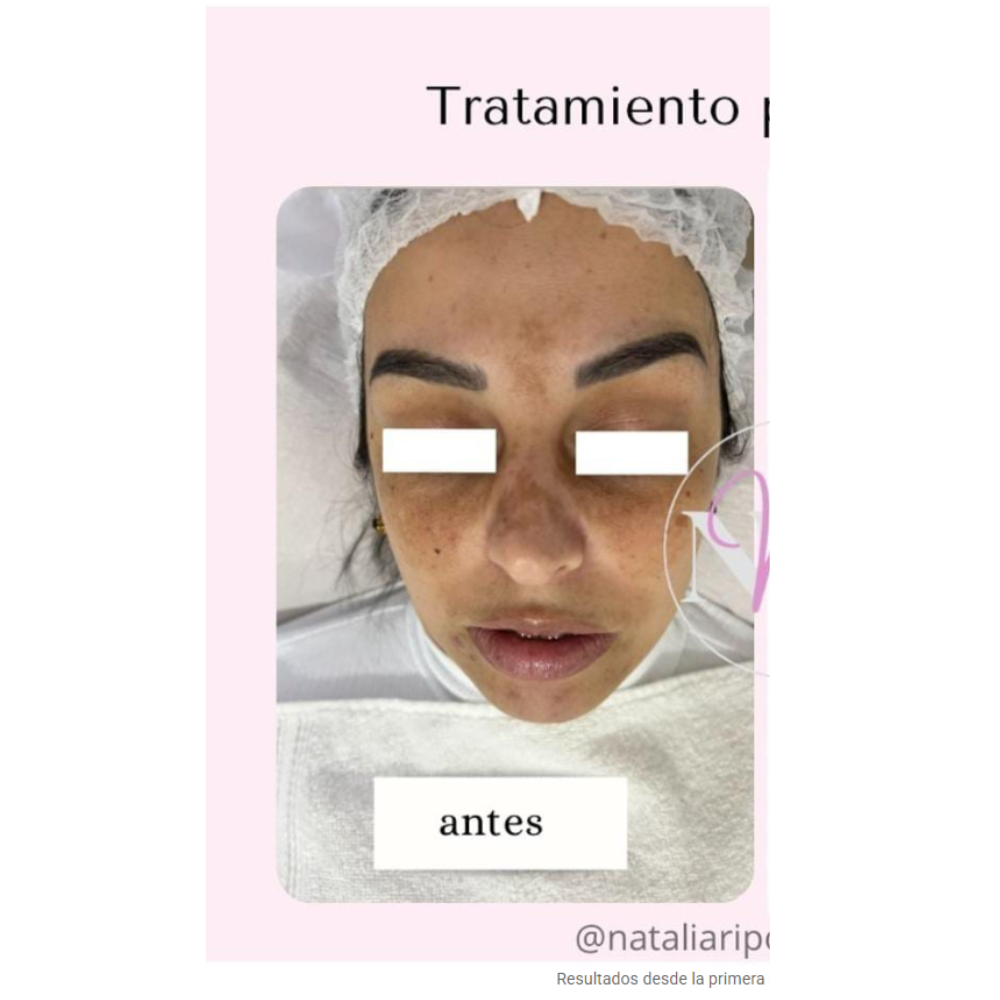 Antes del tratamiento de manchas